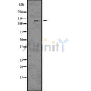 DF7541 at 1/100 staining Human breast cancer tissue by IHC-P. The sample was formaldehyde fixed and a heat mediated antigen retrieval step in citrate buffer was performed. The sample was then blocked and incubated with the antibody for 1.5 hours at 22¡ãC. An HRP conjugated goat anti-rabbit antibody was used as the secondary