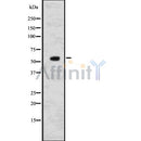 DF7579 at 1/100 staining Human breast cancer tissue by IHC-P. The sample was formaldehyde fixed and a heat mediated antigen retrieval step in citrate buffer was performed. The sample was then blocked and incubated with the antibody for 1.5 hours at 22¡ãC. An HRP conjugated goat anti-rabbit antibody was used as the secondary