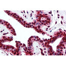 AF0875 at 1/100 staining Human breast cancer tissue by IHC-P. The sample was formaldehyde fixed and a heat mediated antigen retrieval step in citrate buffer was performed. The sample was then blocked and incubated with the antibody for 1.5 hours at 22¡ãC. An HRP conjugated goat anti-rabbit antibody was used as the secondary