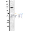 DF8000 at 1/100 staining Human breast cancer tissue by IHC-P. The sample was formaldehyde fixed and a heat mediated antigen retrieval step in citrate buffer was performed. The sample was then blocked and incubated with the antibody for 1.5 hours at 22¡ãC. An HRP conjugated goat anti-rabbit antibody was used as the secondary