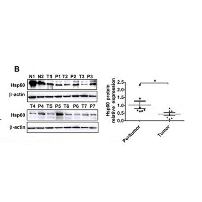  western blot analyses for the mRNA and protein expression of Hsp60 in tumor and paired peritumor tissues from HCC patients. Quantitative analysis of protein levels was performed by measuring the ratio of Hsp60 to ?-actin expression. Error bars indicate SD.*P<0.05.