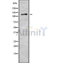 DF8436 at 1/100 staining Human breast cancer tissue by IHC-P. The sample was formaldehyde fixed and a heat mediated antigen retrieval step in citrate buffer was performed. The sample was then blocked and incubated with the antibody for 1.5 hours at 22¡ãC. An HRP conjugated goat anti-rabbit antibody was used as the secondary