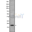 DF8464 at 1/100 staining Human Melanoma tissue by IHC-P. The sample was formaldehyde fixed and a heat mediated antigen retrieval step in citrate buffer was performed. The sample was then blocked and incubated with the antibody for 1.5 hours at 22¡ãC. An HRP conjugated goat anti-rabbit antibody was used as the secondary