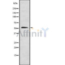 DF8548 at 1/100 staining Human liver cancer tissue by IHC-P. The sample was formaldehyde fixed and a heat mediated antigen retrieval step in citrate buffer was performed. The sample was then blocked and incubated with the antibody for 1.5 hours at 22¡ãC. An HRP conjugated goat anti-rabbit antibody was used as the secondary