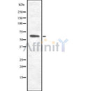 DF8565 at 1/100 staining Human brain cancer tissue by IHC-P. The sample was formaldehyde fixed and a heat mediated antigen retrieval step in citrate buffer was performed. The sample was then blocked and incubated with the antibody for 1.5 hours at 22¡ãC. An HRP conjugated goat anti-rabbit antibody was used as the secondary