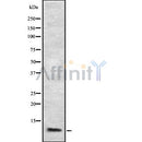 DF8572 at 1/100 staining Human Melanoma tissue by IHC-P. The sample was formaldehyde fixed and a heat mediated antigen retrieval step in citrate buffer was performed. The sample was then blocked and incubated with the antibody for 1.5 hours at 22¡ãC. An HRP conjugated goat anti-rabbit antibody was used as the secondary