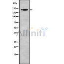 DF8575 at 1/100 staining Human liver cancer tissue by IHC-P. The sample was formaldehyde fixed and a heat mediated antigen retrieval step in citrate buffer was performed. The sample was then blocked and incubated with the antibody for 1.5 hours at 22¡ãC. An HRP conjugated goat anti-rabbit antibody was used as the secondary