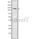 DF8581 at 1/100 staining Human brain cancer tissue by IHC-P. The sample was formaldehyde fixed and a heat mediated antigen retrieval step in citrate buffer was performed. The sample was then blocked and incubated with the antibody for 1.5 hours at 22¡ãC. An HRP conjugated goat anti-rabbit antibody was used as the secondary