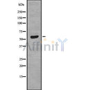 DF8582 at 1/100 staining Human liver cancer tissue by IHC-P. The sample was formaldehyde fixed and a heat mediated antigen retrieval step in citrate buffer was performed. The sample was then blocked and incubated with the antibody for 1.5 hours at 22¡ãC. An HRP conjugated goat anti-rabbit antibody was used as the secondary