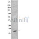 DF8583 at 1/100 staining Human Melanoma tissue by IHC-P. The sample was formaldehyde fixed and a heat mediated antigen retrieval step in citrate buffer was performed. The sample was then blocked and incubated with the antibody for 1.5 hours at 22¡ãC. An HRP conjugated goat anti-rabbit antibody was used as the secondary