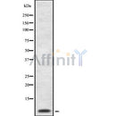 DF8797 at 1/100 staining Human liver cancer tissue by IHC-P. The sample was formaldehyde fixed and a heat mediated antigen retrieval step in citrate buffer was performed. The sample was then blocked and incubated with the antibody for 1.5 hours at 22¡ãC. An HRP conjugated goat anti-rabbit antibody was used as the secondary