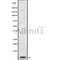 DF8797 at 1/100 staining Human liver cancer tissue by IHC-P. The sample was formaldehyde fixed and a heat mediated antigen retrieval step in citrate buffer was performed. The sample was then blocked and incubated with the antibody for 1.5 hours at 22¡ãC. An HRP conjugated goat anti-rabbit antibody was used as the secondary