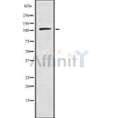 DF8829 at 1/100 staining Human breast cancer tissue by IHC-P. The sample was formaldehyde fixed and a heat mediated antigen retrieval step in citrate buffer was performed. The sample was then blocked and incubated with the antibody for 1.5 hours at 22¡ãC. An HRP conjugated goat anti-rabbit antibody was used as the secondary
