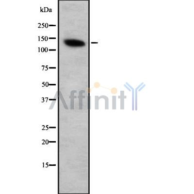 DF8852 at 1/100 staining Human breast cancer tissue by IHC-P. The sample was formaldehyde fixed and a heat mediated antigen retrieval step in citrate buffer was performed. The sample was then blocked and incubated with the antibody for 1.5 hours at 22¡ãC. An HRP conjugated goat anti-rabbit antibody was used as the secondary