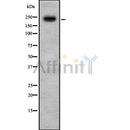 DF8854 at 1/100 staining Human breast cancer tissue by IHC-P. The sample was formaldehyde fixed and a heat mediated antigen retrieval step in citrate buffer was performed. The sample was then blocked and incubated with the antibody for 1.5 hours at 22¡ãC. An HRP conjugated goat anti-rabbit antibody was used as the secondary