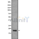 DF8883 at 1/100 staining Human breast cancer tissue by IHC-P. The sample was formaldehyde fixed and a heat mediated antigen retrieval step in citrate buffer was performed. The sample was then blocked and incubated with the antibody for 1.5 hours at 22¡ãC. An HRP conjugated goat anti-rabbit antibody was used as the secondary
