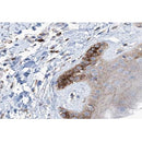 AF0189 at 1/200 staining human skin carcinoma tissue sections by IHC-P. The tissue was formaldehyde fixed and a heat mediated antigen retrieval step in citrate buffer was performed. The tissue was then blocked and incubated with the antibody for 1.5 hours at 22¡ãC. An HRP conjugated goat anti-rabbit antibody was used as the secondary
