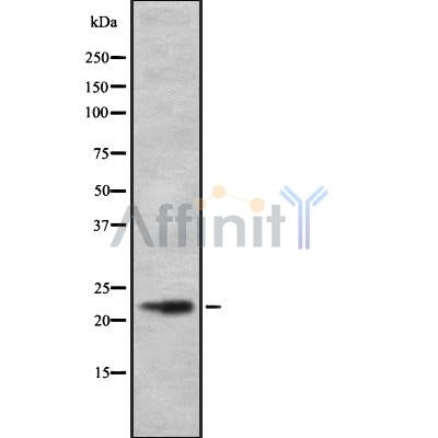 DF8939 at 1/100 staining Human liver cancer tissue by IHC-P. The sample was formaldehyde fixed and a heat mediated antigen retrieval step in citrate buffer was performed. The sample was then blocked and incubated with the antibody for 1.5 hours at 22¡ãC. An HRP conjugated goat anti-rabbit antibody was used as the secondary