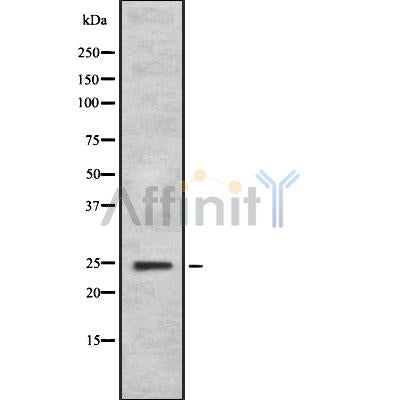 DF8944 at 1/100 staining Human Melanoma tissue by IHC-P. The sample was formaldehyde fixed and a heat mediated antigen retrieval step in citrate buffer was performed. The sample was then blocked and incubated with the antibody for 1.5 hours at 22¡ãC. An HRP conjugated goat anti-rabbit antibody was used as the secondary