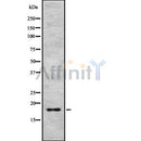 DF8981 at 1/100 staining Human Melanoma tissue by IHC-P. The sample was formaldehyde fixed and a heat mediated antigen retrieval step in citrate buffer was performed. The sample was then blocked and incubated with the antibody for 1.5 hours at 22¡ãC. An HRP conjugated goat anti-rabbit antibody was used as the secondary