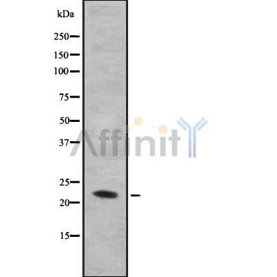 DF8984 at 1/100 staining Human Melanoma tissue by IHC-P. The sample was formaldehyde fixed and a heat mediated antigen retrieval step in citrate buffer was performed. The sample was then blocked and incubated with the antibody for 1.5 hours at 22¡ãC. An HRP conjugated goat anti-rabbit antibody was used as the secondary