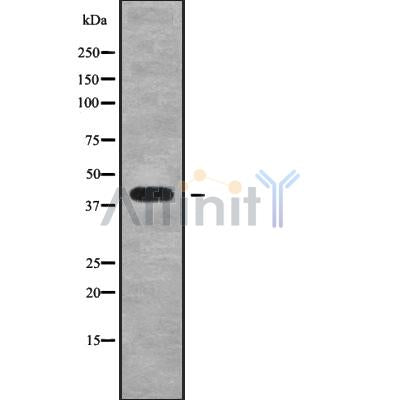 DF9083 at 1/100 staining Human brain cancer tissue by IHC-P. The sample was formaldehyde fixed and a heat mediated antigen retrieval step in citrate buffer was performed. The sample was then blocked and incubated with the antibody for 1.5 hours at 22¡ãC. An HRP conjugated goat anti-rabbit antibody was used as the secondary
