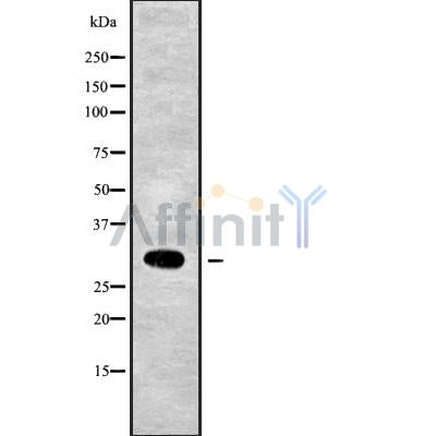 DF9105 at 1/100 staining Human brain cancer tissue by IHC-P. The sample was formaldehyde fixed and a heat mediated antigen retrieval step in citrate buffer was performed. The sample was then blocked and incubated with the antibody for 1.5 hours at 22¡ãC. An HRP conjugated goat anti-rabbit antibody was used as the secondary