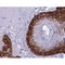 AF0192 at 1/500 staining human colon cancer tissue sections by IHC-P. The tissue was formaldehyde fixed and a heat mediated antigen retrieval step in citrate buffer was performed. The tissue was then blocked and incubated with the antibody for 1.5 hours at 22¡ãC. An HRP conjugated goat anti-rabbit antibody was used as the secondary