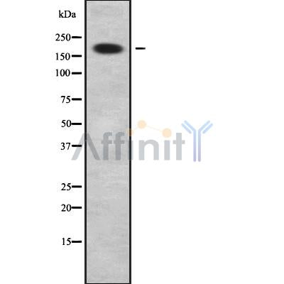 DF9255 at 1/100 staining Human urothelial cancer tissue by IHC-P. The sample was formaldehyde fixed and a heat mediated antigen retrieval step in citrate buffer was performed. The sample was then blocked and incubated with the antibody for 1.5 hours at 22¡ãC. An HRP conjugated goat anti-rabbit antibody was used as the secondary