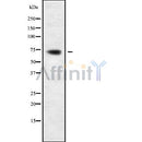 DF9256 at 1/100 staining Human breast cancer tissue by IHC-P. The sample was formaldehyde fixed and a heat mediated antigen retrieval step in citrate buffer was performed. The sample was then blocked and incubated with the antibody for 1.5 hours at 22¡ãC. An HRP conjugated goat anti-rabbit antibody was used as the secondary