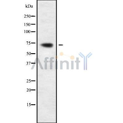 DF9256 at 1/100 staining Human breast cancer tissue by IHC-P. The sample was formaldehyde fixed and a heat mediated antigen retrieval step in citrate buffer was performed. The sample was then blocked and incubated with the antibody for 1.5 hours at 22¡ãC. An HRP conjugated goat anti-rabbit antibody was used as the secondary