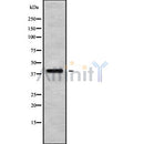 BNIPL Antibody on lung cancer by IHC.