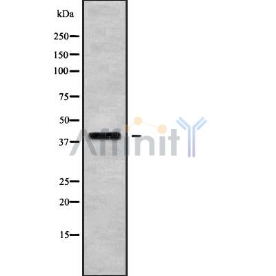 BNIPL Antibody on lung cancer by IHC.