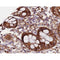 AF0193 at 1/200 staining human colon carcinoma tissue sections by IHC-P. The tissue was formaldehyde fixed and a heat mediated antigen retrieval step in citrate buffer was performed. The tissue was then blocked and incubated with the antibody for 1.5 hours at 22¡ãC. An HRP conjugated goat anti-rabbit antibody was used as the secondary