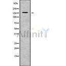 DF9339 at 1/100 staining Human liver cancer tissue by IHC-P. The sample was formaldehyde fixed and a heat mediated antigen retrieval step in citrate buffer was performed. The sample was then blocked and incubated with the antibody for 1.5 hours at 22¡ãC. An HRP conjugated goat anti-rabbit antibody was used as the secondary
