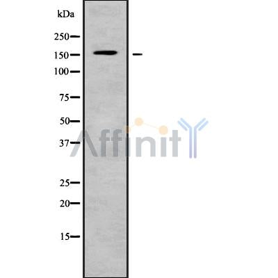 DF9339 at 1/100 staining Human liver cancer tissue by IHC-P. The sample was formaldehyde fixed and a heat mediated antigen retrieval step in citrate buffer was performed. The sample was then blocked and incubated with the antibody for 1.5 hours at 22¡ãC. An HRP conjugated goat anti-rabbit antibody was used as the secondary