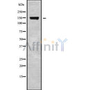 DF9366 at 1/100 staining Human brain cancer tissue by IHC-P. The sample was formaldehyde fixed and a heat mediated antigen retrieval step in citrate buffer was performed. The sample was then blocked and incubated with the antibody for 1.5 hours at 22¡ãC. An HRP conjugated goat anti-rabbit antibody was used as the secondary