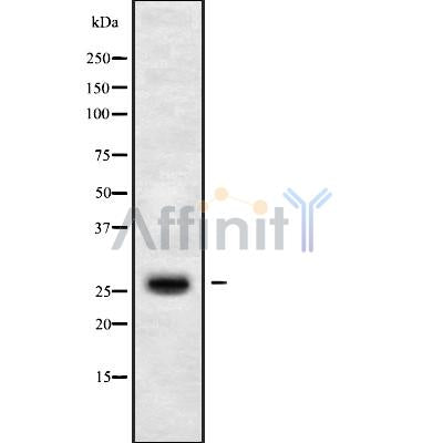 DF9391 at 1/100 staining Human liver cancer tissue by IHC-P. The sample was formaldehyde fixed and a heat mediated antigen retrieval step in citrate buffer was performed. The sample was then blocked and incubated with the antibody for 1.5 hours at 22¡ãC. An HRP conjugated goat anti-rabbit antibody was used as the secondary
