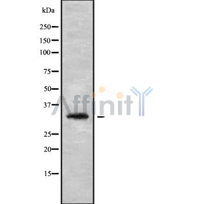 DF9395 at 1/100 staining Human liver cancer tissue by IHC-P. The sample was formaldehyde fixed and a heat mediated antigen retrieval step in citrate buffer was performed. The sample was then blocked and incubated with the antibody for 1.5 hours at 22¡ãC. An HRP conjugated goat anti-rabbit antibody was used as the secondary