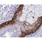 AF0194 at 1/100 staining human colon cancer tissue by IHC-P. The sample was formaldehyde fixed and a heat mediated antigen retrieval step in citrate buffer was performed. The sample was then blocked and incubated with the antibody for 1.5 hours at 22¡ãC. An HRP conjugated goat anti-rabbit antibody was used as the secondary