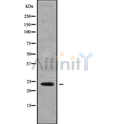 DF9492 at 1/100 staining Human brain cancer tissue by IHC-P. The sample was formaldehyde fixed and a heat mediated antigen retrieval step in citrate buffer was performed. The sample was then blocked and incubated with the antibody for 1.5 hours at 22¡ãC. An HRP conjugated goat anti-rabbit antibody was used as the secondary