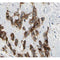 AF0195 at 1/200 staining human breast carcinoma tissue sections by IHC-P. The tissue was formaldehyde fixed and a heat mediated antigen retrieval step in citrate buffer was performed. The tissue was then blocked and incubated with the antibody for 1.5 hours at 22¡ãC. An HRP conjugated goat anti-rabbit antibody was used as the secondary