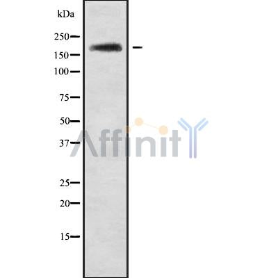 DF9682 at 1/100 staining Human brain cancer tissue by IHC-P. The sample was formaldehyde fixed and a heat mediated antigen retrieval step in citrate buffer was performed. The sample was then blocked and incubated with the antibody for 1.5 hours at 22¡ãC. An HRP conjugated goat anti-rabbit antibody was used as the secondary