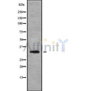 DF9699 at 1/100 staining Human liver cancer tissue by IHC-P. The sample was formaldehyde fixed and a heat mediated antigen retrieval step in citrate buffer was performed. The sample was then blocked and incubated with the antibody for 1.5 hours at 22¡ãC. An HRP conjugated goat anti-rabbit antibody was used as the secondary