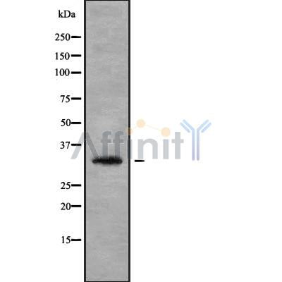 DF9699 at 1/100 staining Human liver cancer tissue by IHC-P. The sample was formaldehyde fixed and a heat mediated antigen retrieval step in citrate buffer was performed. The sample was then blocked and incubated with the antibody for 1.5 hours at 22¡ãC. An HRP conjugated goat anti-rabbit antibody was used as the secondary