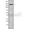 DF9760 at 1/100 staining Human liver cancer tissue by IHC-P. The sample was formaldehyde fixed and a heat mediated antigen retrieval step in citrate buffer was performed. The sample was then blocked and incubated with the antibody for 1.5 hours at 22¡ãC. An HRP conjugated goat anti-rabbit antibody was used as the secondary
