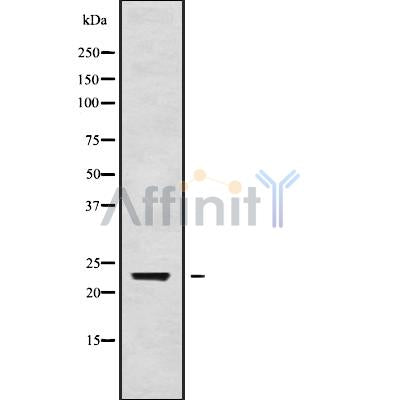 DF9822 at 1/100 staining Human cervical cancer tissue by IHC-P. The sample was formaldehyde fixed and a heat mediated antigen retrieval step in citrate buffer was performed. The sample was then blocked and incubated with the antibody for 1.5 hours at 22¡ãC. An HRP conjugated goat anti-rabbit antibody was used as the secondary