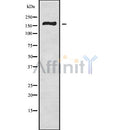 DF9842 at 1/100 staining Human liver cancer tissue by IHC-P. The sample was formaldehyde fixed and a heat mediated antigen retrieval step in citrate buffer was performed. The sample was then blocked and incubated with the antibody for 1.5 hours at 22¡ãC. An HRP conjugated goat anti-rabbit antibody was used as the secondary