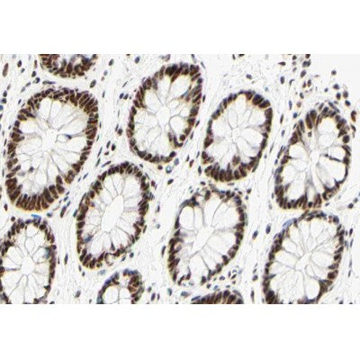 AF0200 at 1/100 staining human colon carcinoma tissue sections by IHC-P. The tissue was formaldehyde fixed and a heat mediated antigen retrieval step in citrate buffer was performed. The tissue was then blocked and incubated with the antibody for 1.5 hours at 22¡ãC. An HRP conjugated goat anti-rabbit antibody was used as the secondary