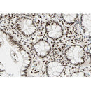 AF0206 at 1/100 staining human colon carcinoma tissue sections by IHC-P. The tissue was   formaldehyde fixed and a heat mediated antigen retrieval step in citrate buffer was   performed. The tissue was then blocked and incubated with the antibody for 1.5 hours at 22  ¡ãC. An HRP conjugated goat anti-rabbit antibody was used as the secondary
